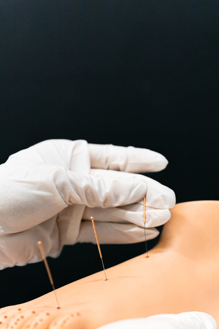 Close-up of a gloved hand performing acupuncture on a model arm with fine needles.